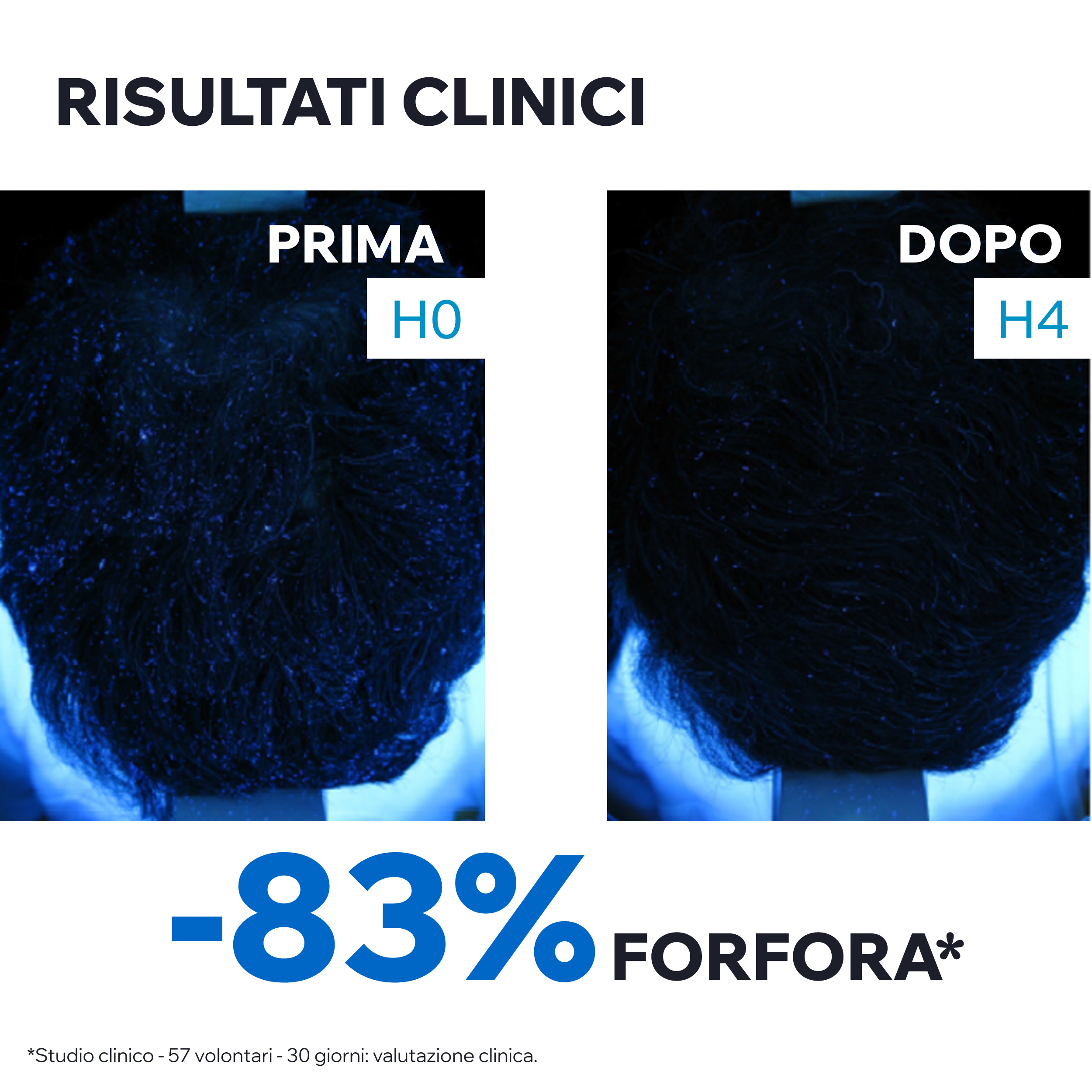 Uriage DS Hair - Lozione Antiforfora Intensiva Per Forfora Grassa O Secca 100 ml