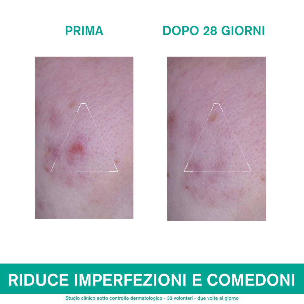 HYSÉAC - 3-REGUL+ Trattamento Globale Anti-imperfezioni per brufoli, punti neri e segni post-acne 40ML