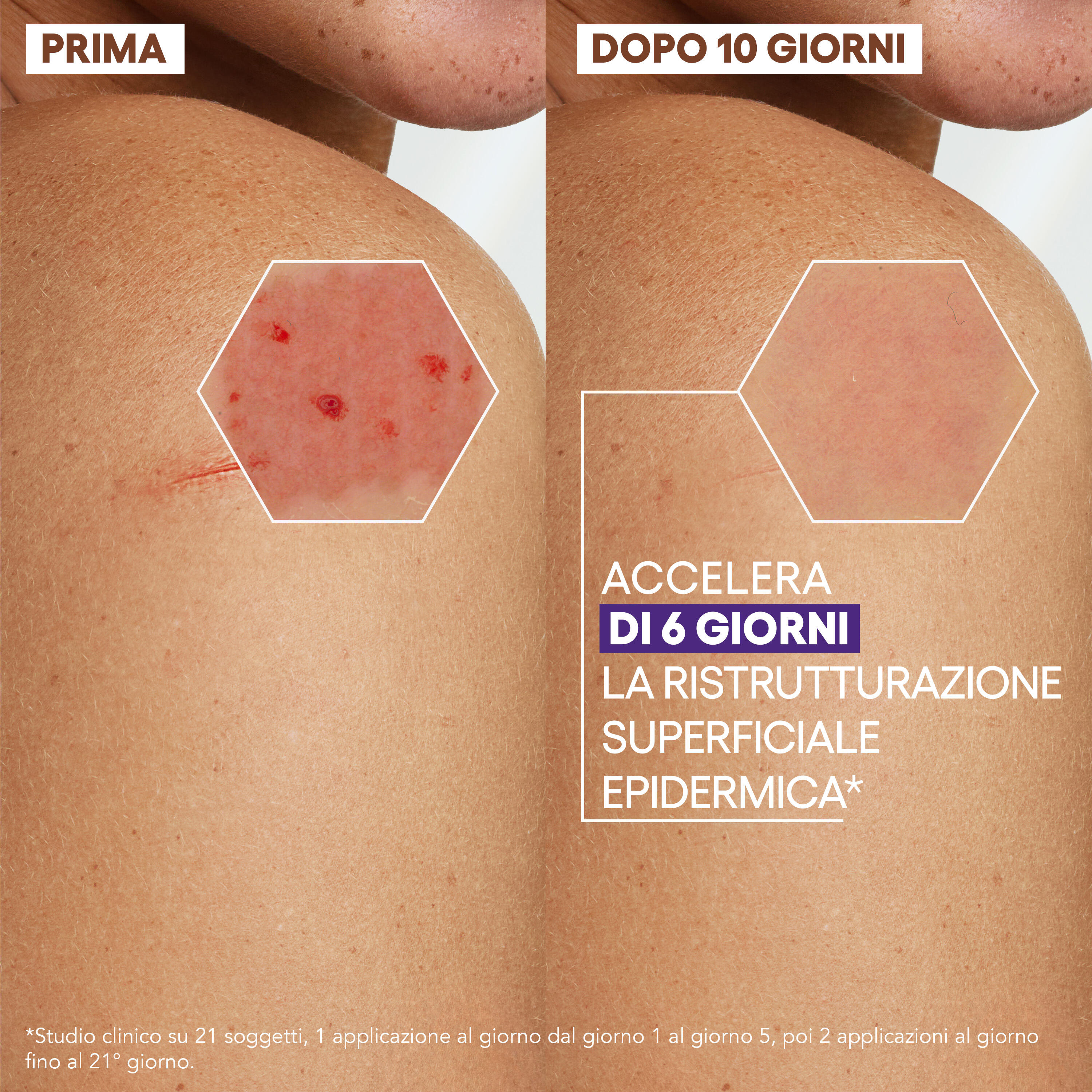 A-Derma Epitheliale Ultra Repair - Crema Ristrutturante Anti-Segni Residui 100 ml