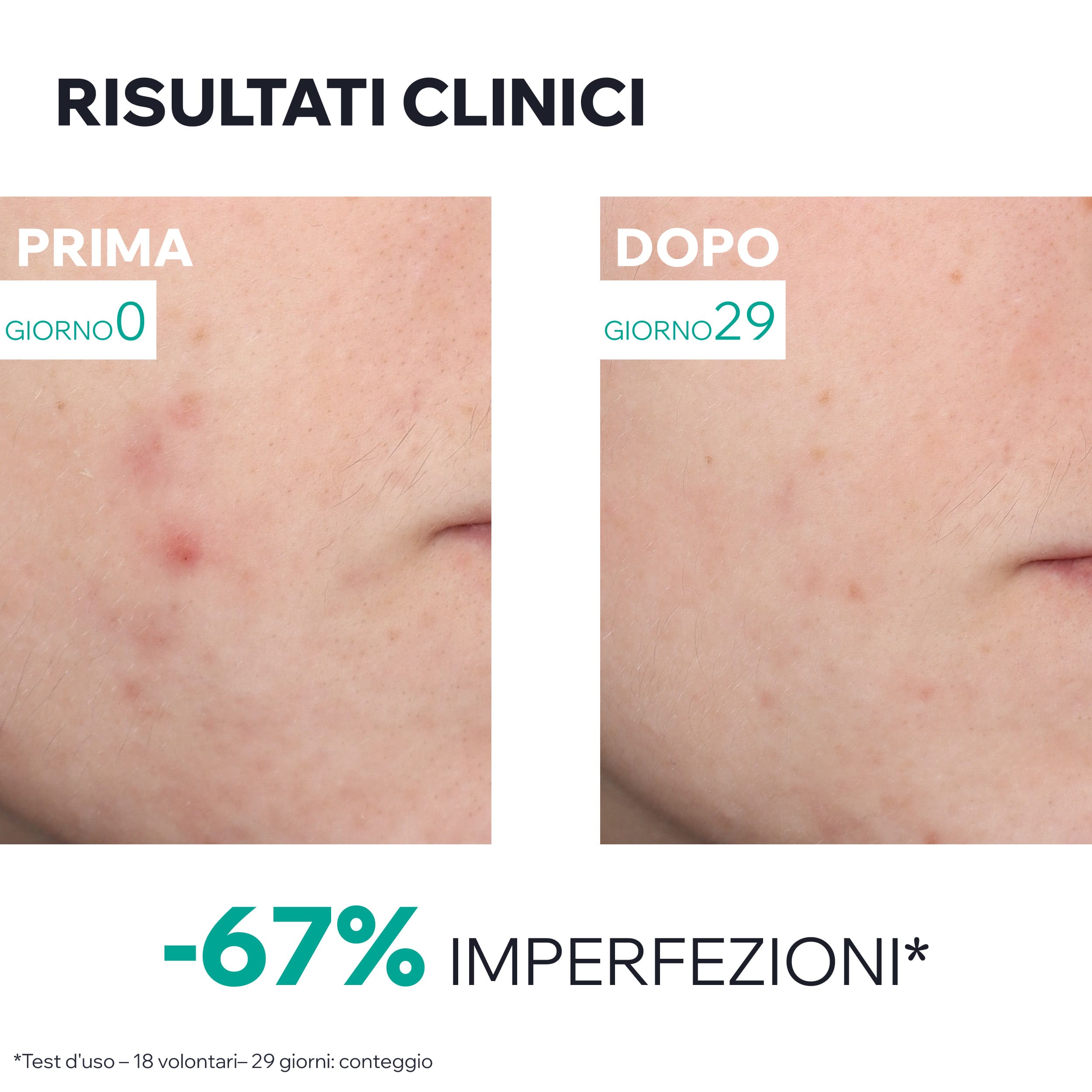 Uriage - Hyséac - Siero Pelle Nuova Booster Anti-Imperfezioni 30 ml