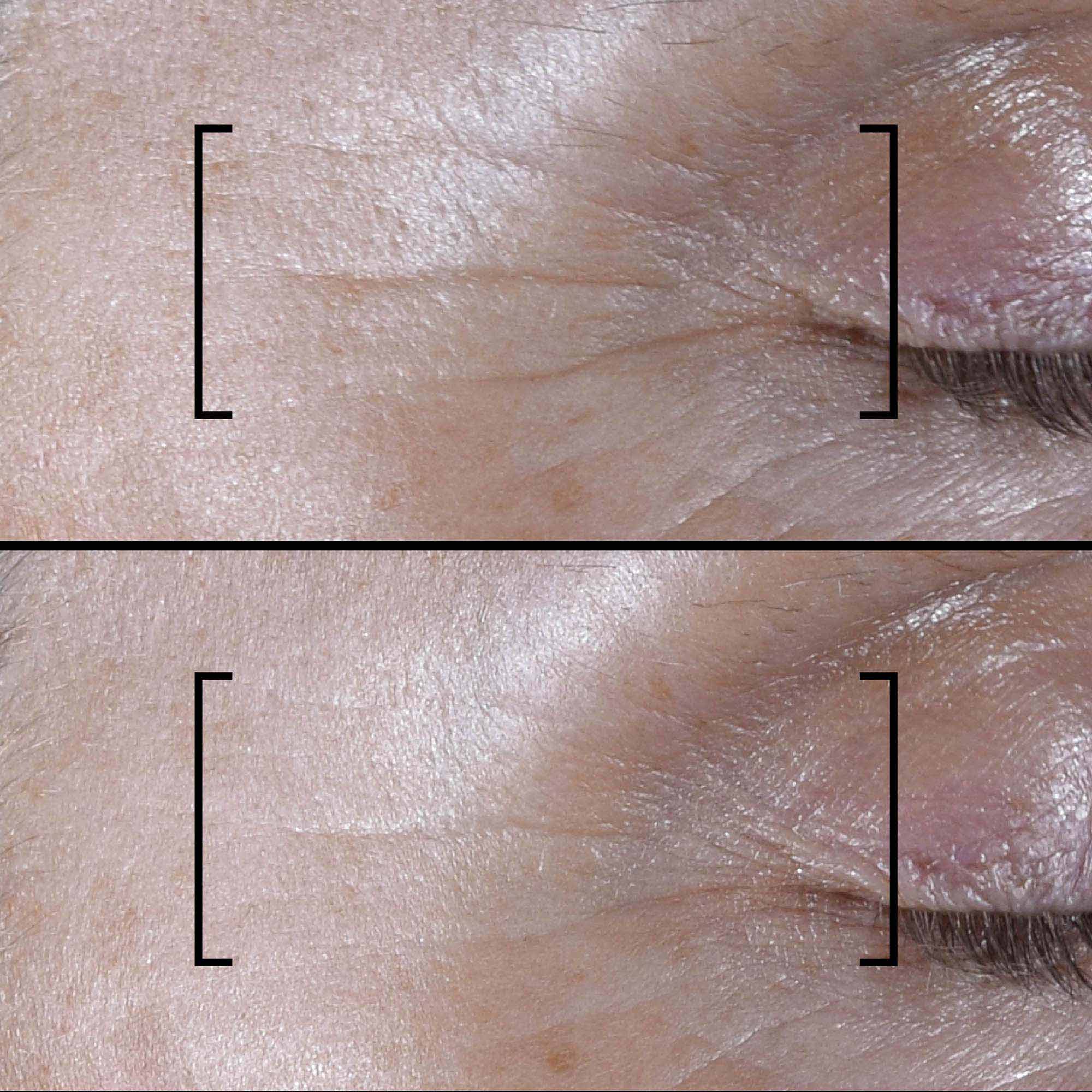 Filorga - Time-Filler Shot 5XP - Siero Concentrato Per Rughe D'Espressione 15 ml