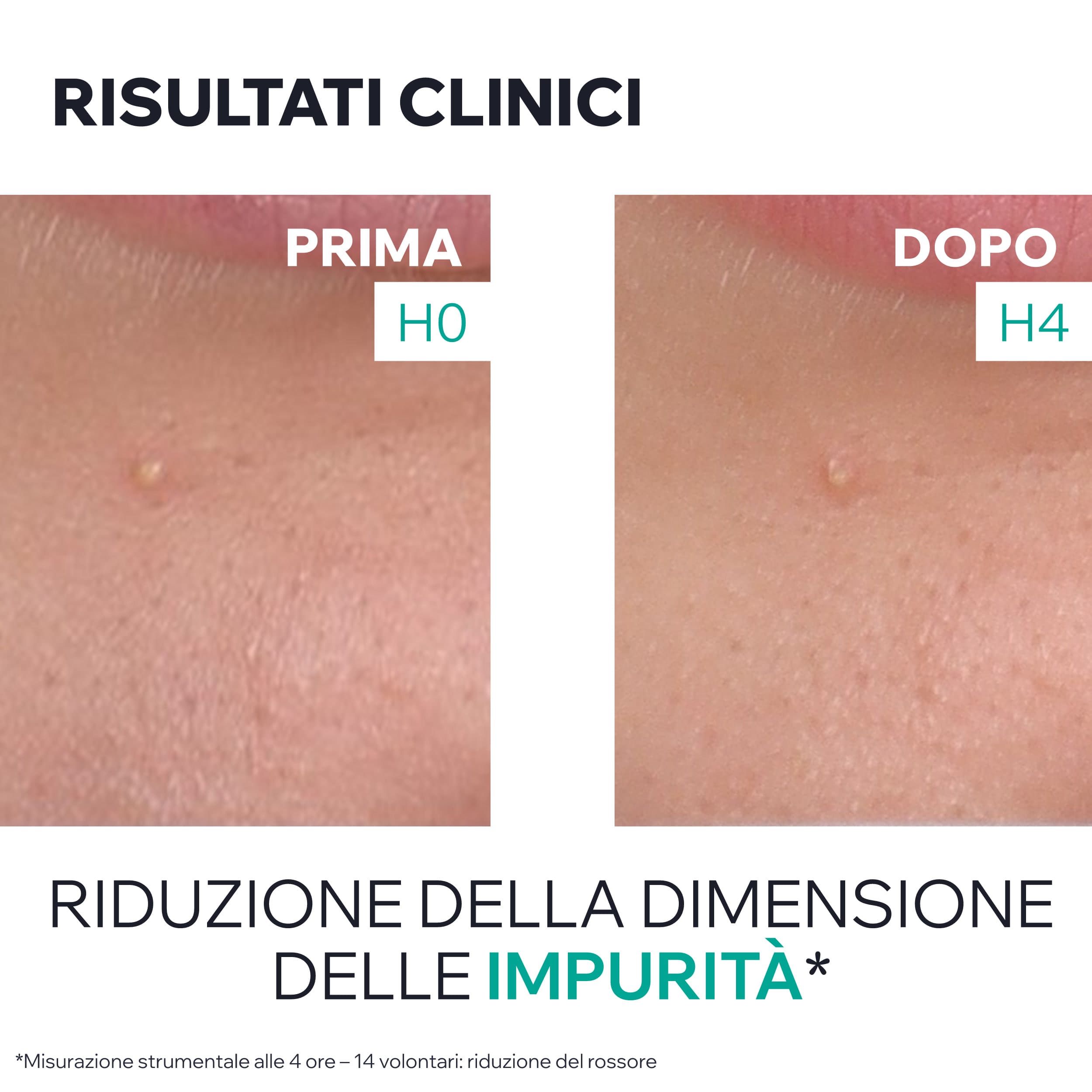 Uriage - Hyséac - Gel SOS Purificante Anti-Imperfezioni Viso 15 ml