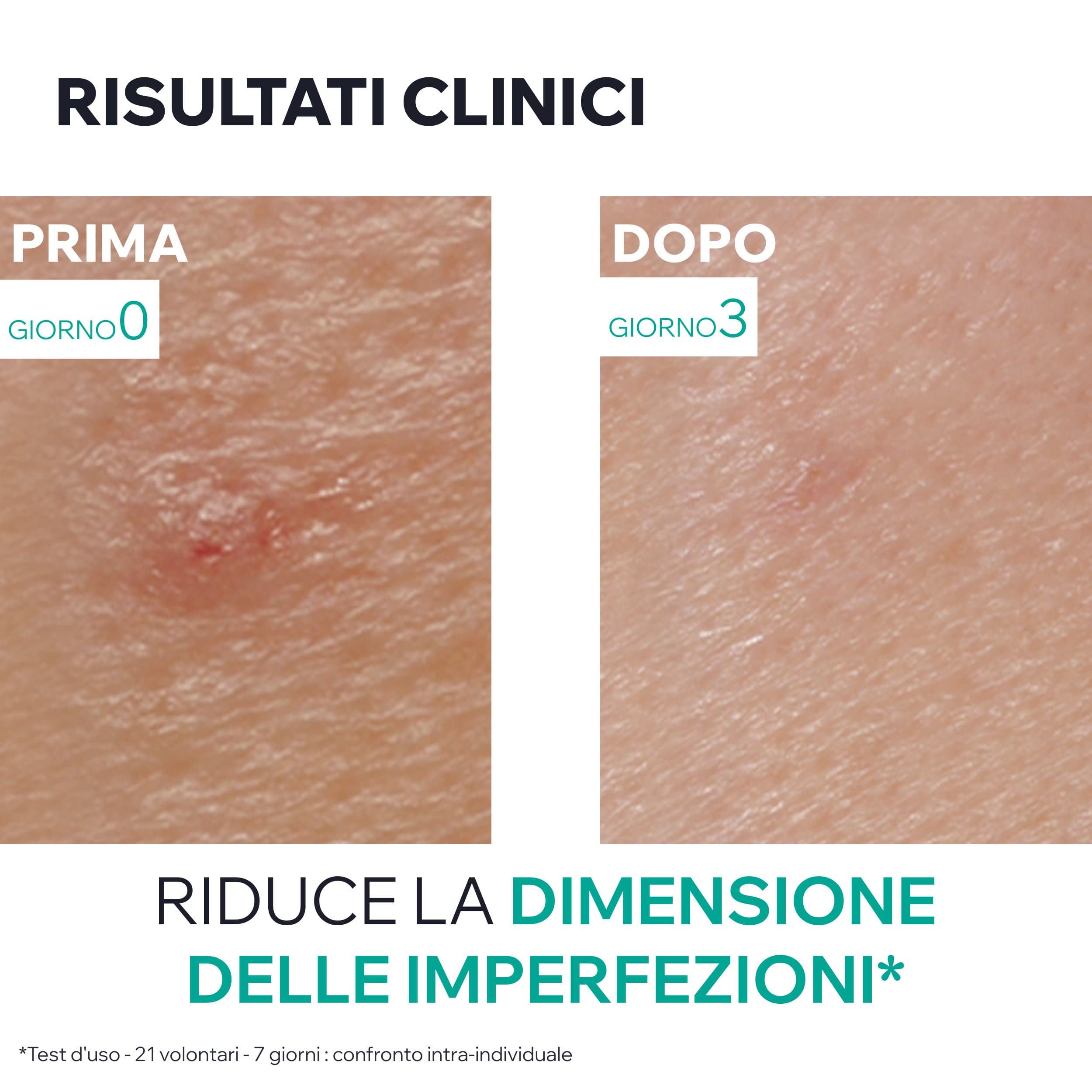 Uriage - Hyséac - Pasta SOS Anti-Imperfezioni Viso 15 g