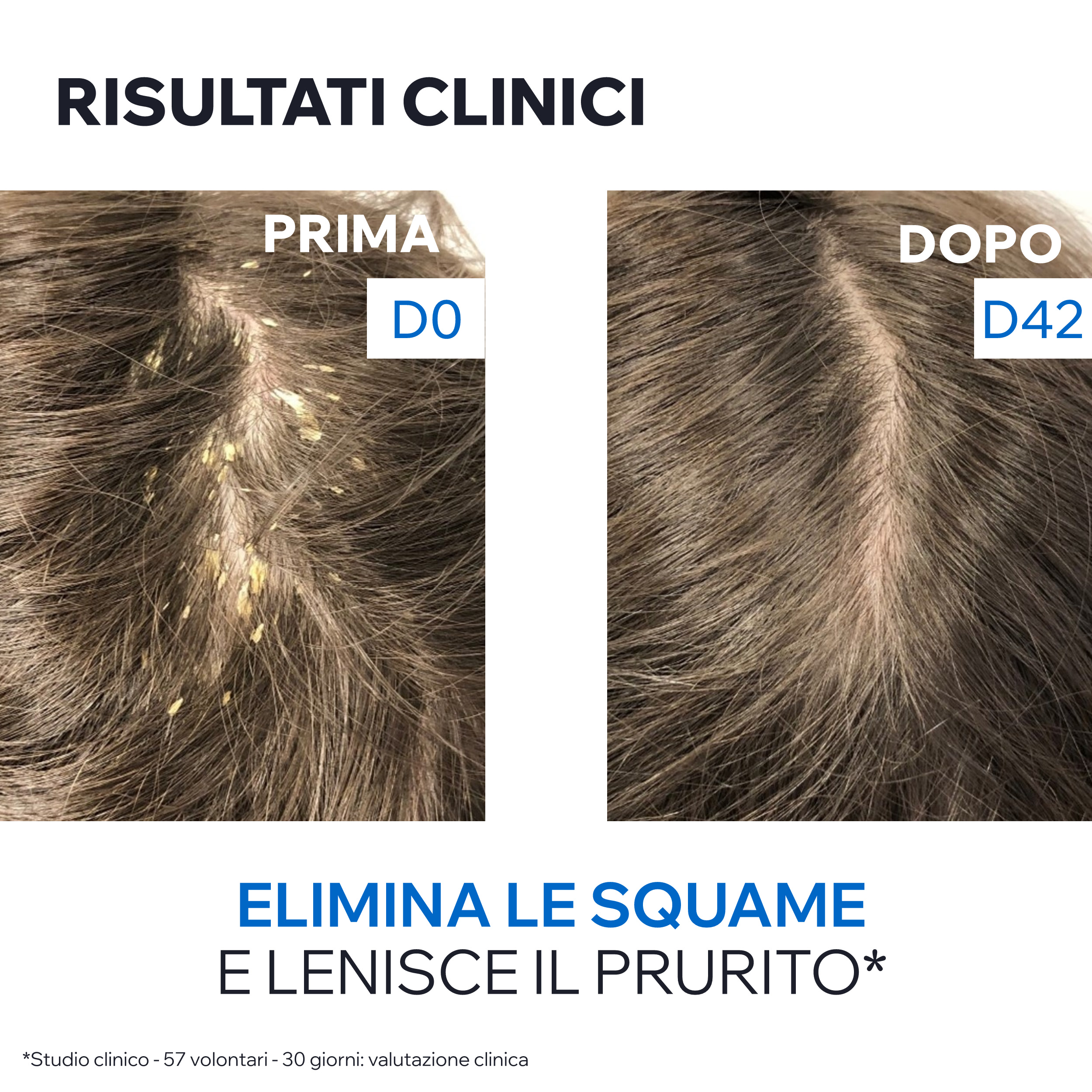 Uriage DS Hair - Shampoo Cheratoriduttore Per Forfora Severa, Secca E Grassa 150 ml