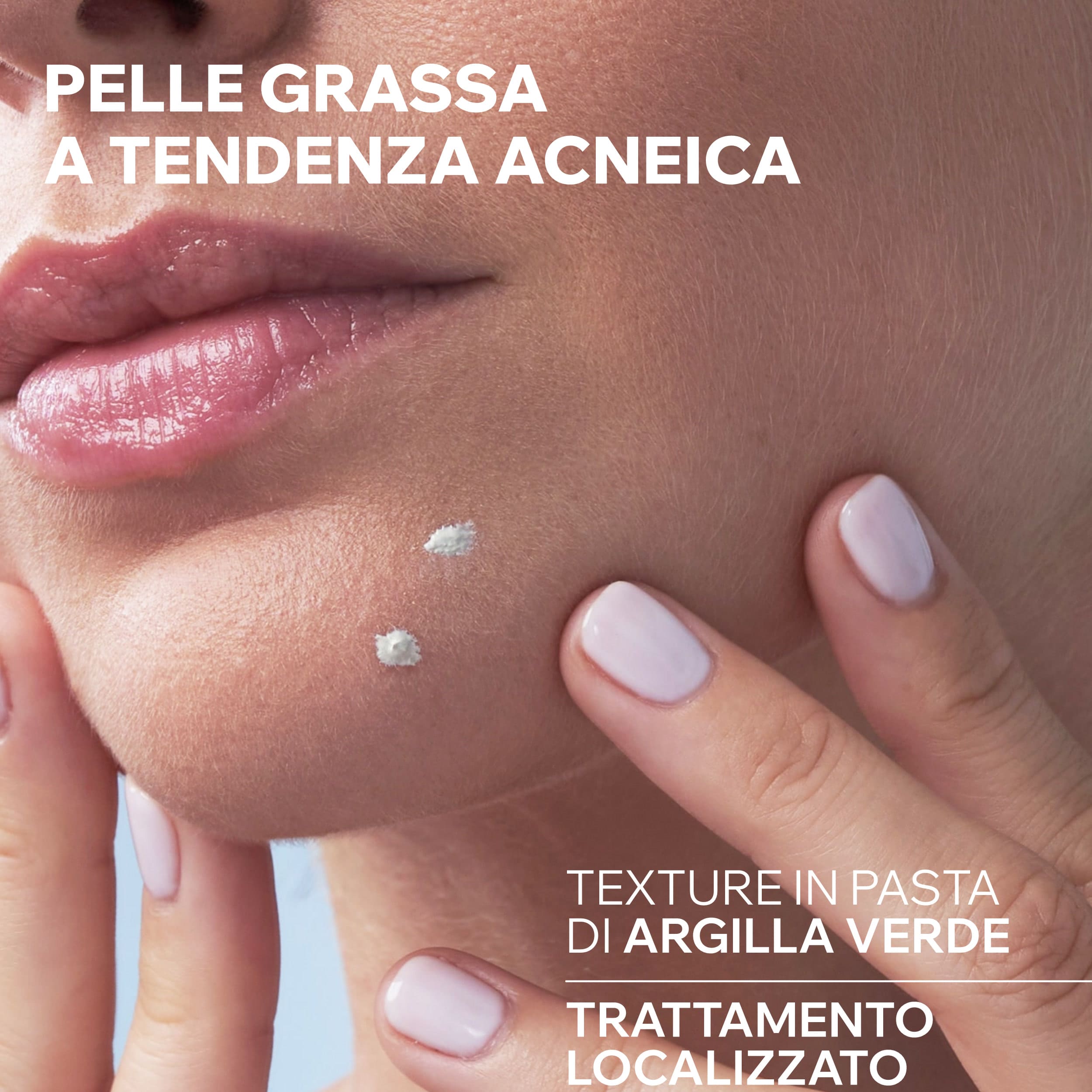 Uriage - Hyséac - Pasta SOS Anti-Imperfezioni Viso 15 g